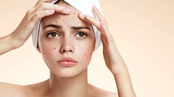 What are 3 easy steps to treat blackheads and spots, and how can charcoal help?