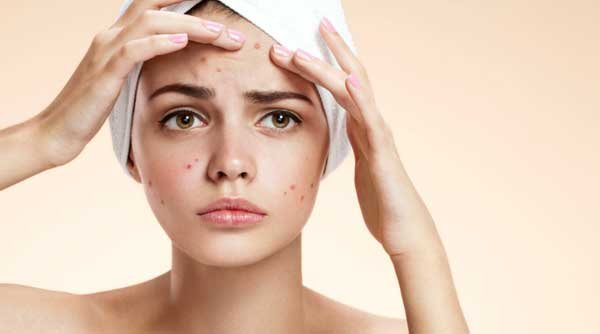Why isn’t the sun an acne cure, and how do you protect spot-prone skin?