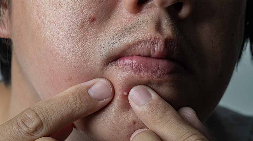 Tips To Combat Summer Acne For Men