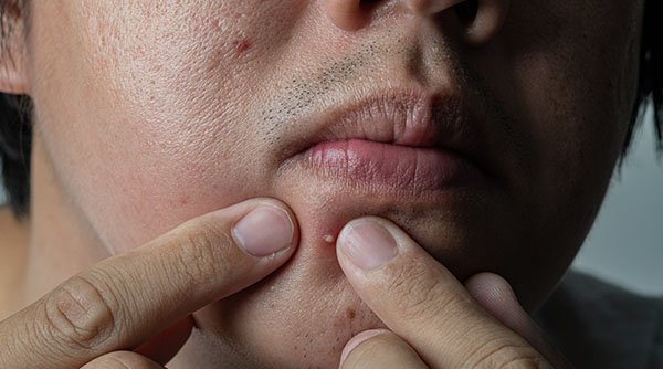 Tips To Combat Summer Acne For Men