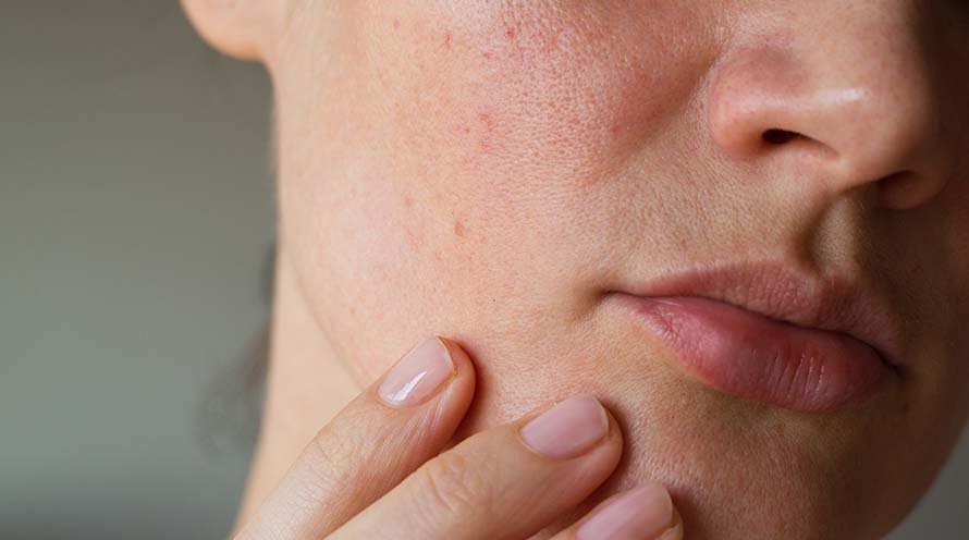 3 Ways to Choose the Best Moisturizer for Combination Skin