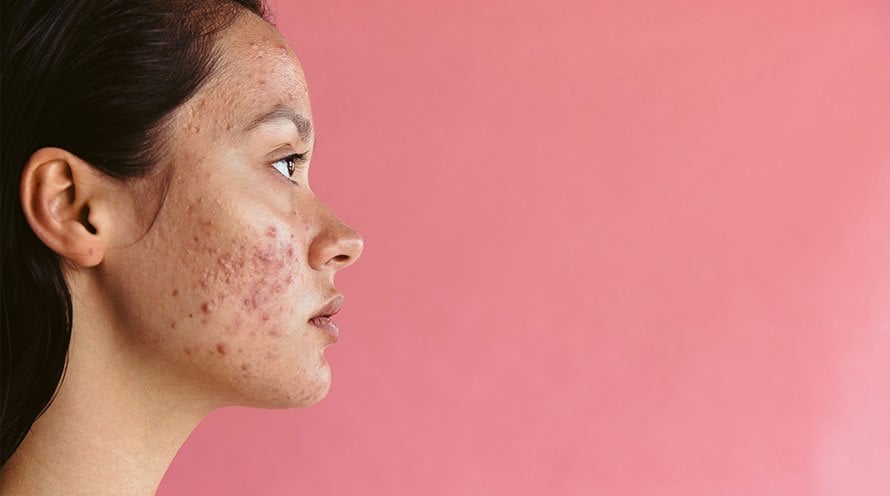 5 acne-causing foods you must avoid!
