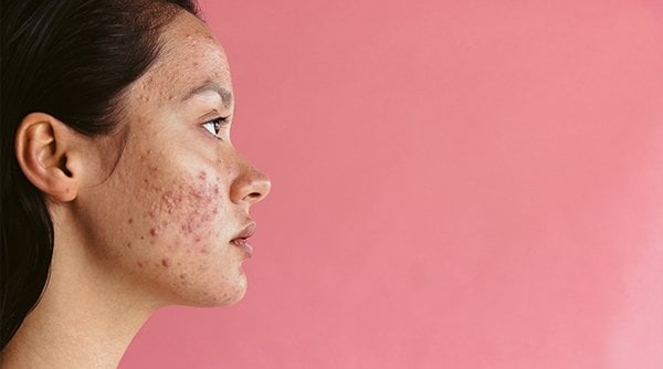 5 acne-causing foods you must avoid! - Garnier Inida 5 acne-causing foods you must avoid! - Garnier Inida