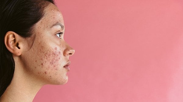 5 acne-causing foods you must avoid!