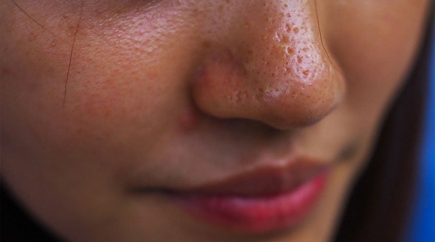 6 main reasons for oily skin!