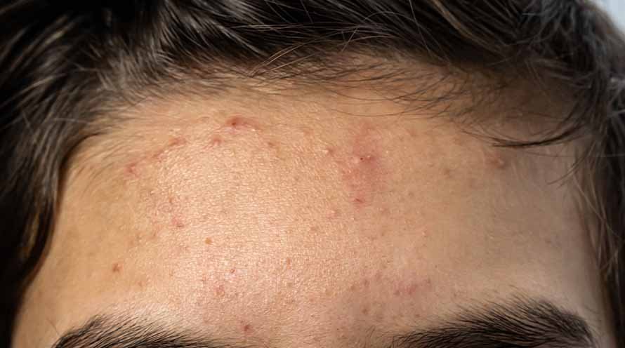 Forehead online pimples cause