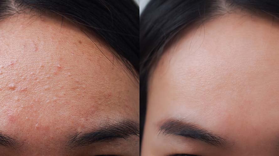 7 Forehead Pimple Treatments