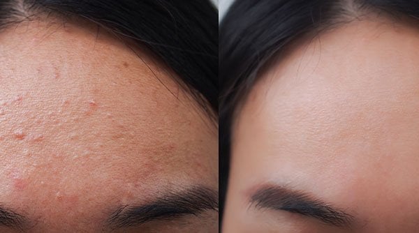 7 Forehead Pimple Treatments 