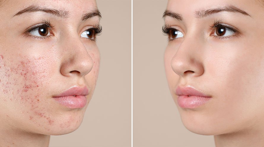 Adult acne 101: Acne solutions!