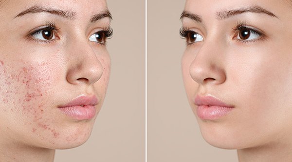 Adult acne 101: Acne solutions!
