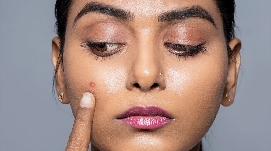 Causes of Adult Acne