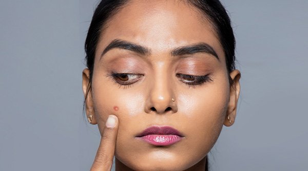 Causes of Adult Acne