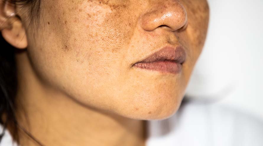 Causes of facial hyperpigmentation