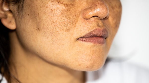 Causes of facial hyperpigmentation