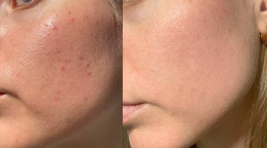 dry skin vs combination skin