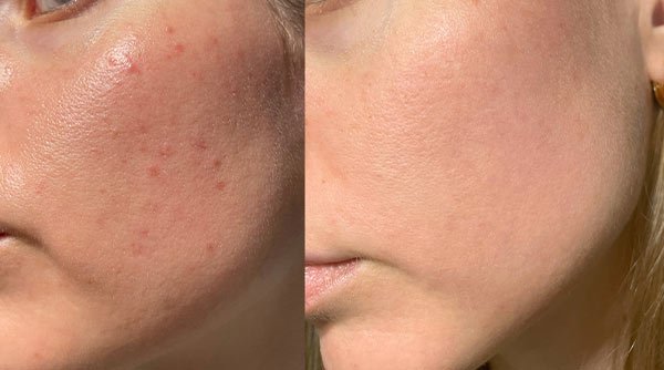 dry skin vs combination skin