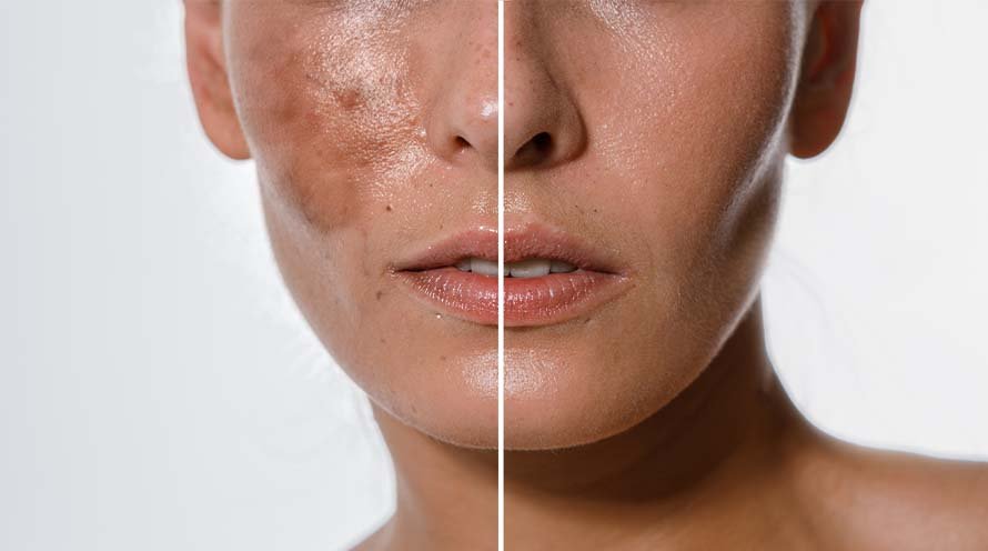 How To Use Hyaluronic Acid For Hyperpigmentation