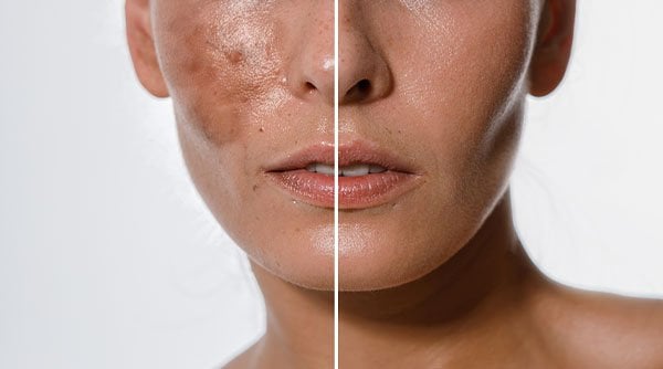 How To Use Hyaluronic Acid For Hyperpigmentation
