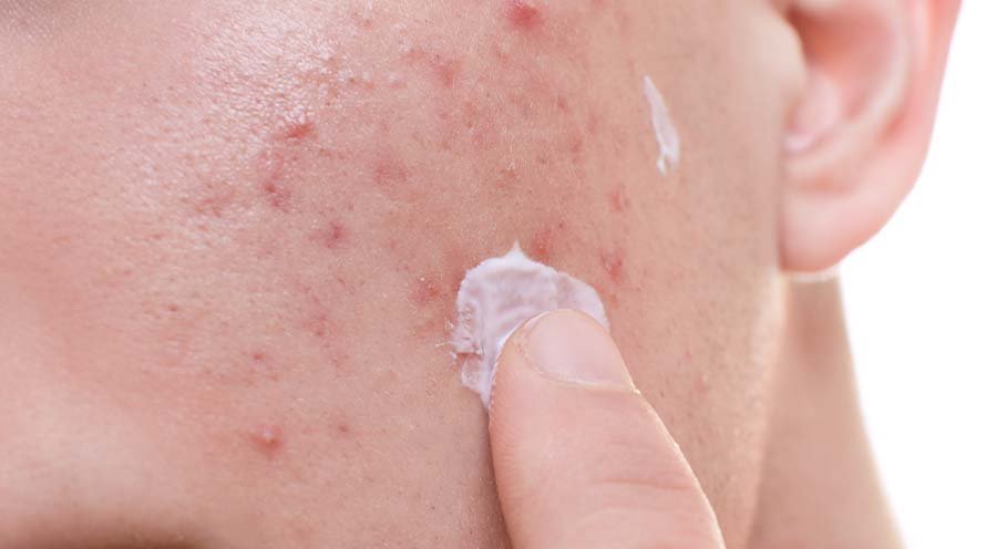 Niacinamide for Acne