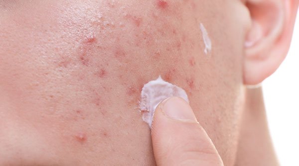 Niacinamide for Acne