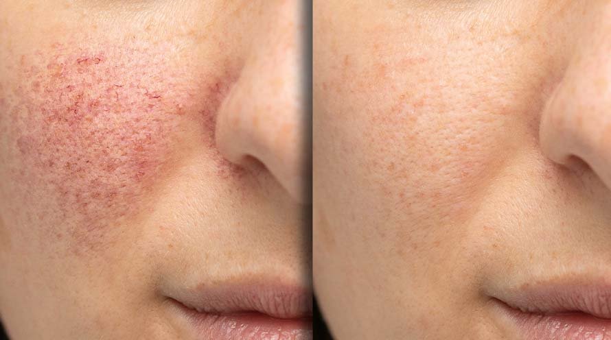 Niacinamide Uses and Benefits