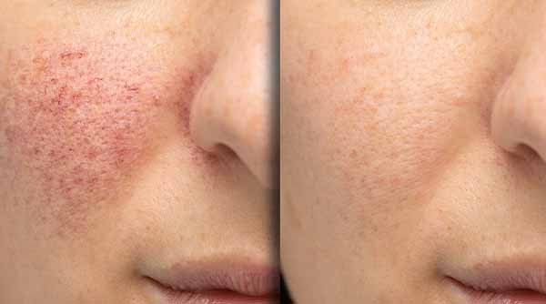 Niacinamide Uses and Benefits