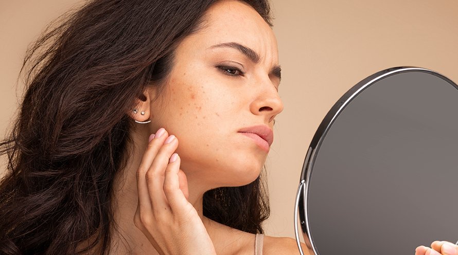 Salicylic Acid for Pimples and Acne