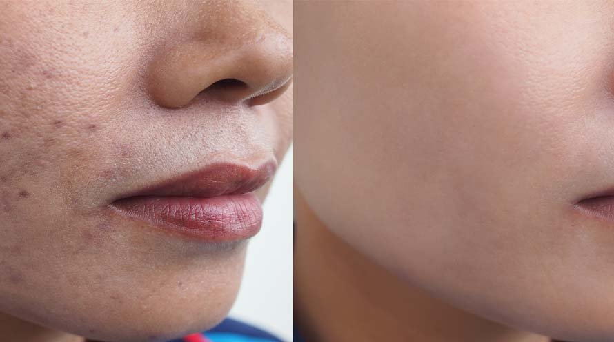 What Is Acne Pigmentation? Causes and Solutions