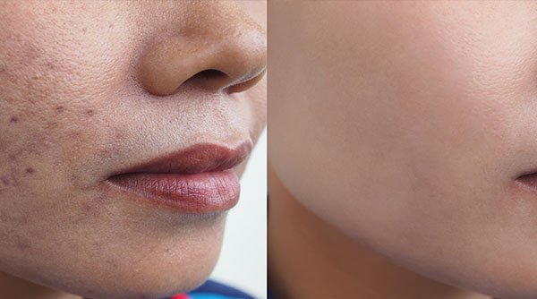 Hyperpigmentation acne cheap