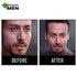 Garnier Men Anti Pimple Treatment Kit - Before After Image
